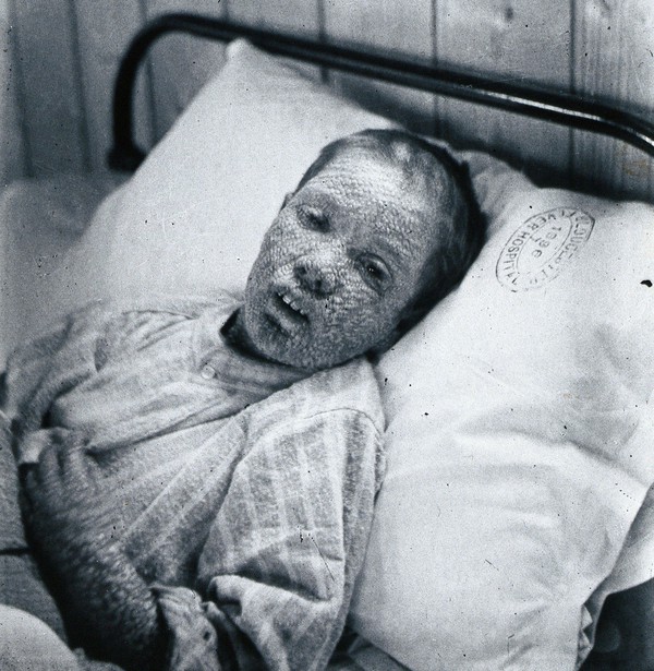 Ethel Cromwell In Hosptial 1896